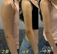 重庆抽脂哪家医院好？重