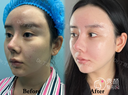 上海丁昆琨苹果肌复位怎么样？苹果肌双U型脂肪式复位+零切口筋膜折叠提升术后1个月反馈 ​​​