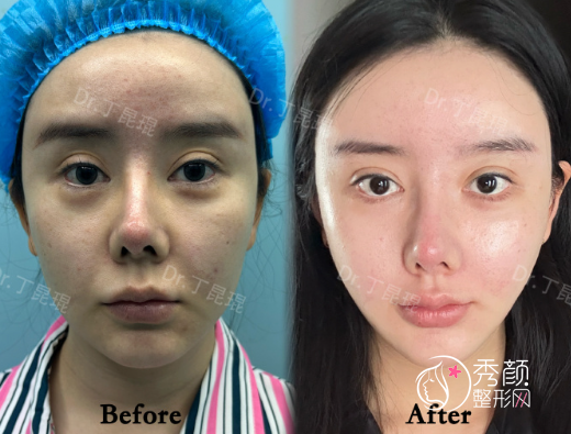 上海丁昆琨苹果肌复位怎么样？苹果肌双U型脂肪式复位+零切口筋膜折叠提升术后1个月反馈 ​​​