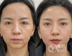 上海脂肪填充整形医院哪