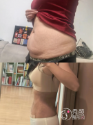 郑州三甲医院哪个吸脂好