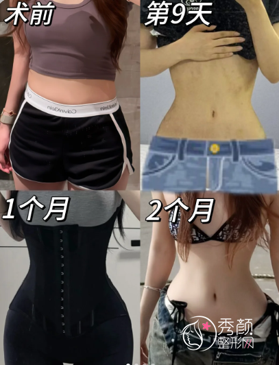 北京腰腹吸脂哪家医院好？北京腰腹吸脂排名前十的医院合集