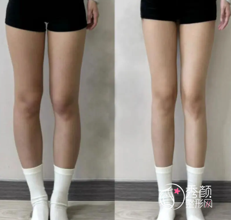 成都吸脂医生排名曝光：李烈、蒲小兵、潘红伟、赵兴阳赫然在列！