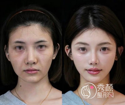 杭州注射微调哪家医院好？杭州艺星审美好，杭州米兰柏羽名气大！