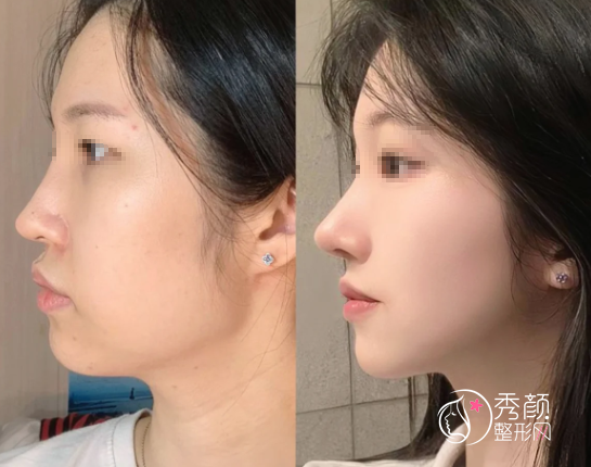 成都磨骨做得好的医生：罗恩、赵延峰、李运峰、张立天等医生