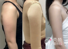 杭州做吸脂厉害的医生：