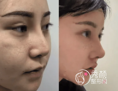 北京鼻修复大咖都有谁？巫文云、李劲良、王旭东、连凯峰等大佬审美口碑在线