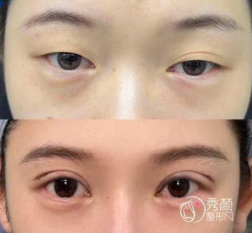 上海双眼皮大佬合集！高段位+技术牛医生整理！不看后悔！