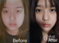 北京双眼皮整形医院排名：北京协和|北京美莱|北京华韩|北京画美…热力上榜