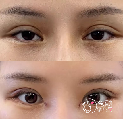 上海做双眼皮修复好的医院有哪些？艺星、薇琳、伊莱美…个个人气旺