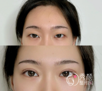 长沙哪家医院双眼皮技术好？湘雅系医院整形科名列前茅