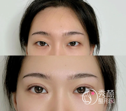 长沙哪家医院双眼皮技术好？湘雅系医院整形科名列前茅