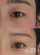 武汉双眼皮做的好的医院