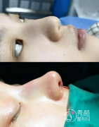 武汉隆鼻有名气的医生排