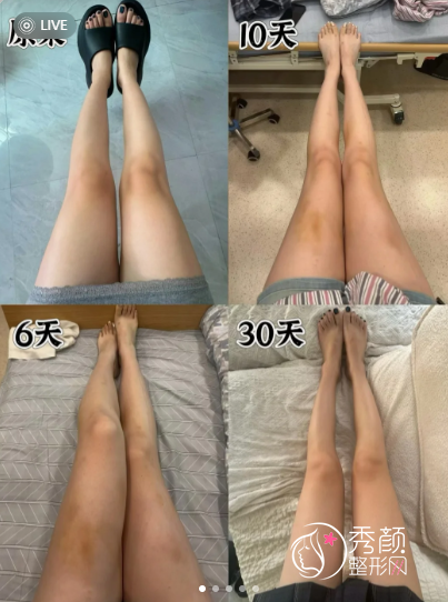 广州抽脂好的医生有哪些？张涛、彭栋梁、朱云、王世虎…