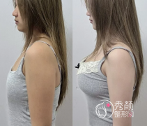 广州隆胸手术哪家医院好？中山一院、省人民医院、华美、曙光、韩妃