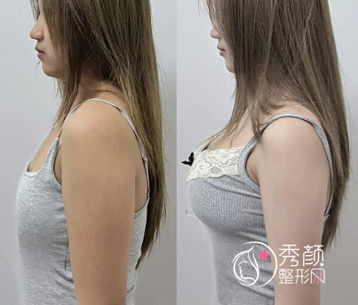 广州隆胸手术哪家医院好？中山一院、省人民医院、华美、曙光、韩妃