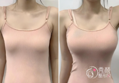 杭州好的丰胸医院是哪家？浙大一院、浙大二院、杭州薇琳、杭州格莱美…