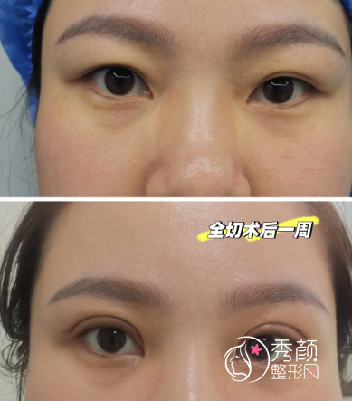 西安双眼皮医生排行榜：马显杰、王俊河、王仁根、鲁新礼…人气很高