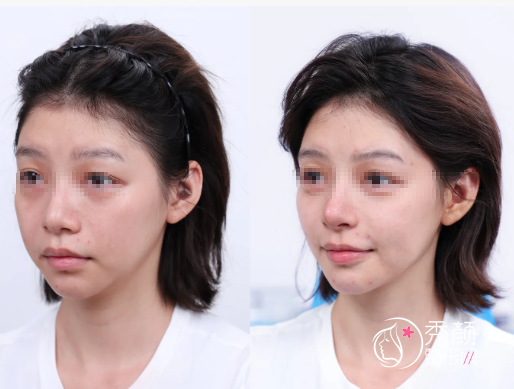 上海微整注射医院哪家好？专业的轮廓固定整形医院名单发布