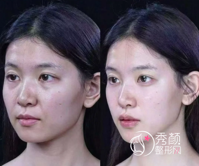 北京微整注射医生哪个好？冯永强、刘岩等都是玻尿酸填充的实力专家