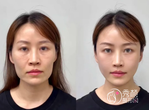 长沙微整注射医生哪个好？倪胜德、尹敏、雷颖…玻尿酸注射实力强