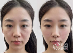 广州微整注射医生哪个好？李丰霞、曾东、徐亚红、冯志勇…