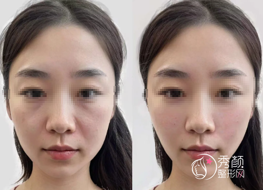 广州微整注射医生哪个好？李丰霞、曾东、徐亚红、冯志勇…