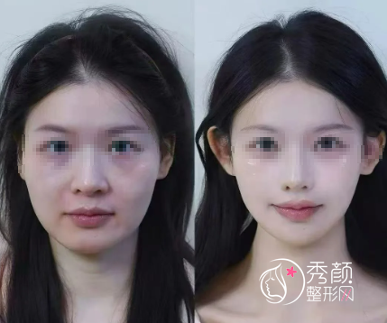 深圳微整注射医生哪个好？张佳佳、富娜、黄凯、卜会营…针尖艺术家