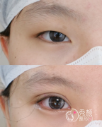 广州双眼皮哪家医院好？
