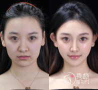 沈阳微整注射医生哪个好