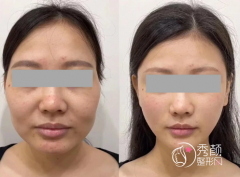 厦门微整注射医生哪个好？刘菁菁、张晓英、王珺、陈晓辉…玻尿酸注射实力强