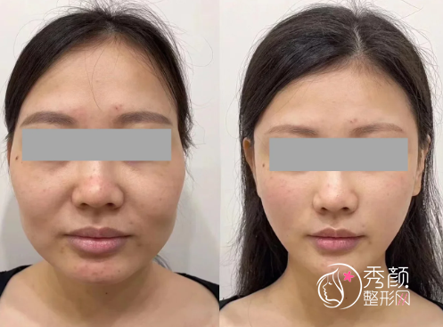 厦门微整注射医生哪个好？刘菁菁、张晓英、王珺、陈晓辉…玻尿酸注射实力强