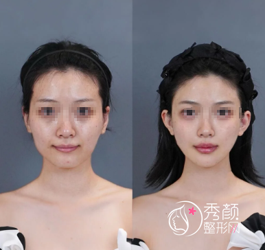 重庆微整注射医院哪家好？盘点幼态脸塑造实力强的整形医院