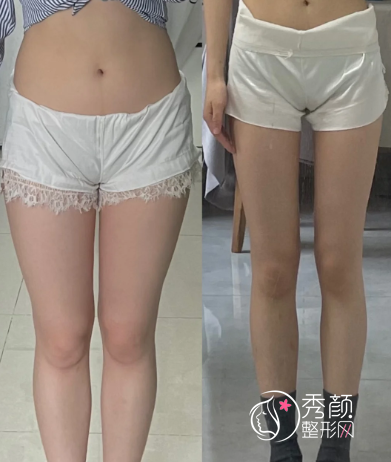 上海九院吸脂大概多少钱？附吸脂大佬及价格表一览