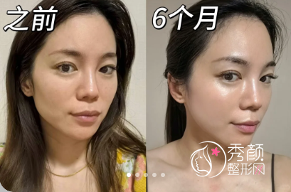 上海九院脂肪填充专家排名曝光，人气医生名单揭晓！