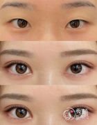 北京割双眼皮的医院哪家好？盘点技术水准在线、审美出众的实力机构