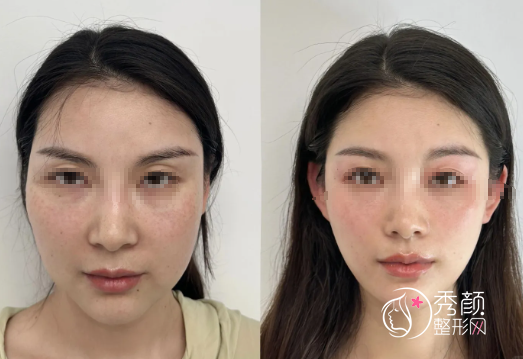 天津轮廓固定医院哪家好？美莱、维美、欧菲、爱丽诺…注射水平高