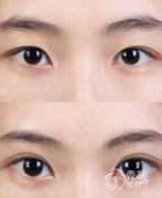 郑州割双眼皮好的正规医
