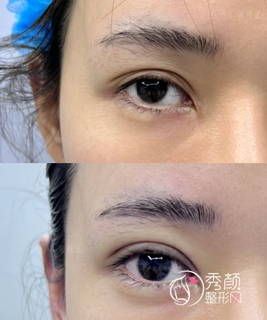 哈尔滨双眼皮修复好的医生排名：任丽虹、郝立君、陈富全、刘非…