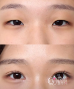 武汉双眼皮做的好的医生排名：郭亮、吴小蔚、鹿世江、吴秀英…专业度强