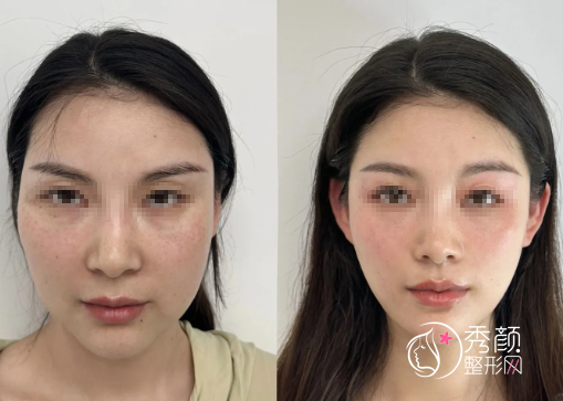 合肥微整注射医生哪个好？汪春兰、赵李平、张恩军、张庆…人气很旺