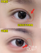 长沙做双眼皮好的医生有