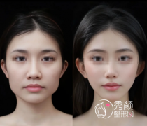 广州磨下颌角的医院有哪