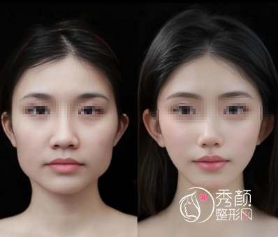 广州磨下颌角的医院有哪些？省人民医院、南方医院、中山大学附一院…名列前茅