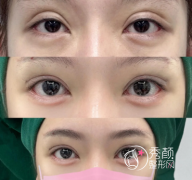 合肥修复双眼皮好的医院