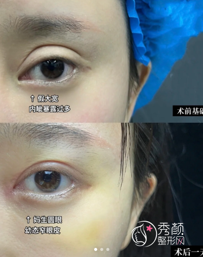 深圳双眼皮修复医生排名：李郴华、林茂辉、吕瑛、黄俊超…实力靠前