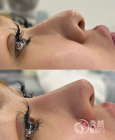 武汉注射玻尿酸隆鼻好的医生是谁？李琳、江岳、贺建平…优势多多