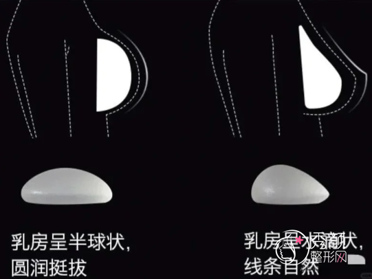 隆胸假体光面、毛面、圆形、水滴？哪个好？优缺点科普
