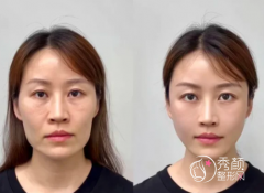 兰州做轮廓固定哪家好？